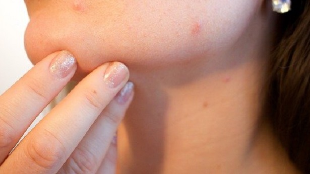 5 dicas para amenizar os efeitos causados pela acne - saude