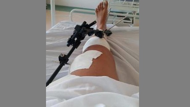 SAJ: Mulher quebra uma das pernas após ataque de cachorros - saj, bahia