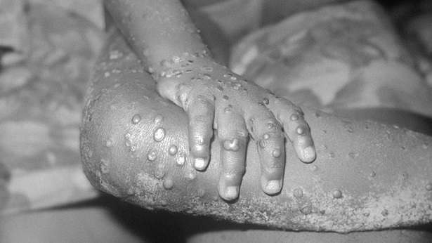Salvador confirma 12º caso de varíola dos macacos - salvador, bahia