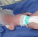 Bebê tem braço quebrado durante nascimento - salvador, destaque