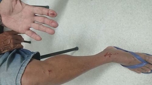 Manoel dos Reis Souza, conhecido como Reizinho, após ser atacado por uma raposa em Varzedo